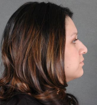 rhinoplasty - patient 5812 - before 3 rhinoplasty - patient 5812 - before 3