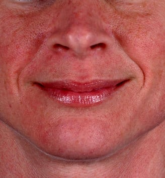juvéderm - patient 6087 - before 1 juvéderm - patient 6087 - before 1