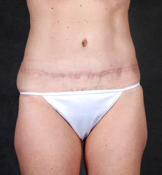 liposuction - patient 4078 - after 1 liposuction - patient 4078 - after 1