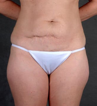 liposuction - patient 4078 - before 1 liposuction - patient 4078 - before 1