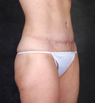 liposuction - patient 4078 - after 2 liposuction - patient 4078 - after 2