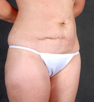 liposuction - patient 4078 - before 2 liposuction - patient 4078 - before 2