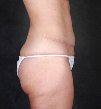liposuction - patient 4078 - after 3 liposuction - patient 4078 - after 3