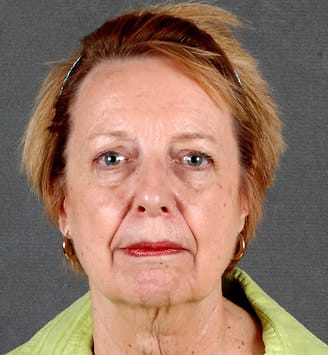 genioplasty - patient 5682 - before 1 genioplasty - patient 5682 - before 1