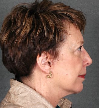 genioplasty - patient 5682 - after 3 genioplasty - patient 5682 - after 3