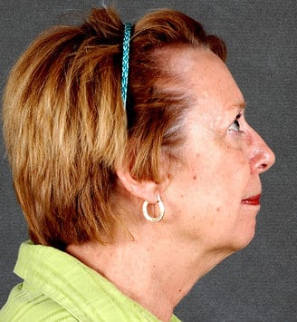 genioplasty - patient 5682 - before 3 genioplasty - patient 5682 - before 3