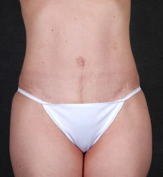 tummy tuck - patient 4824 - after 1 tummy tuck - patient 4824 - after 1