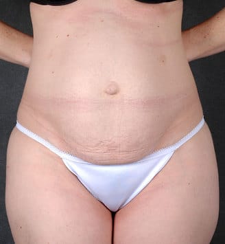 tummy tuck - patient 4824 - before 1 tummy tuck - patient 4824 - before 1