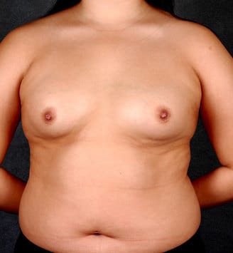 breast augmentation - patient 4225 - before 1 breast augmentation - patient 4225 - before 1