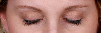 latisse - patient 6098 - after 1 latisse - patient 6098 - after 1
