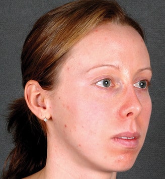 obagi skin care - patient 6111 - after 2 obagi skin care - patient 6111 - after 2