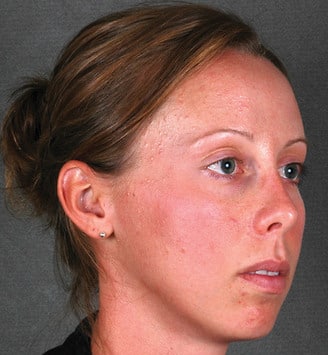 obagi skin care - patient 6111 - before 2 obagi skin care - patient 6111 - before 2