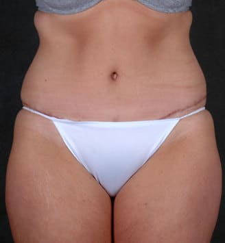 liposuction - patient 4139 - after 1 liposuction - patient 4139 - after 1