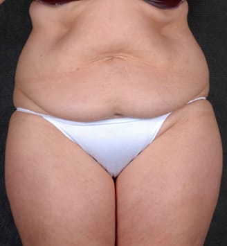 liposuction - patient 4139 - before 1 liposuction - patient 4139 - before 1