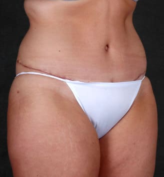liposuction - patient 4139 - after 2 liposuction - patient 4139 - after 2