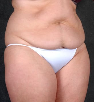 liposuction - patient 4139 - before 2 liposuction - patient 4139 - before 2