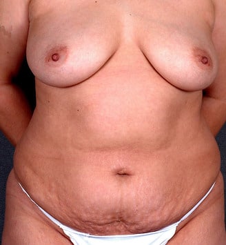 tummy tuck - patient 4905 - before 1 tummy tuck - patient 4905 - before 1
