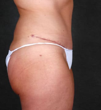 liposuction - patient 4139 - after 3 liposuction - patient 4139 - after 3