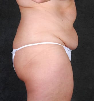 liposuction - patient 4139 - before 3 liposuction - patient 4139 - before 3