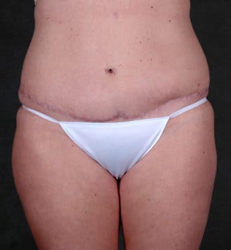 liposuction - patient 3848 - after 1 liposuction - patient 3848 - after 1