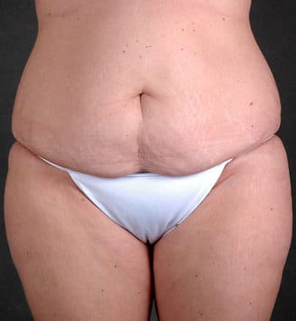 liposuction - patient 3848 - before 1 liposuction - patient 3848 - before 1