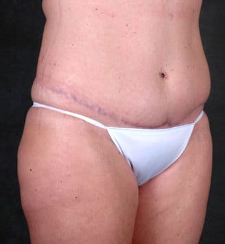 liposuction - patient 3848 - after 2 liposuction - patient 3848 - after 2