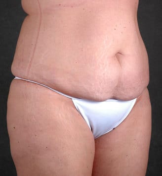 liposuction - patient 3848 - before 2 liposuction - patient 3848 - before 2