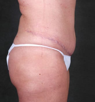 liposuction - patient 3848 - after 3 liposuction - patient 3848 - after 3