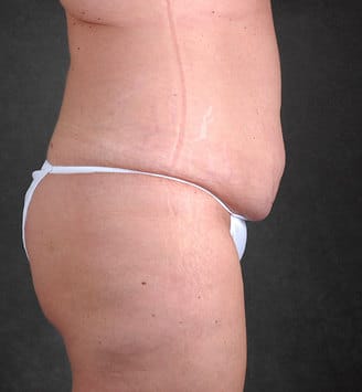 liposuction - patient 3848 - before 3 liposuction - patient 3848 - before 3