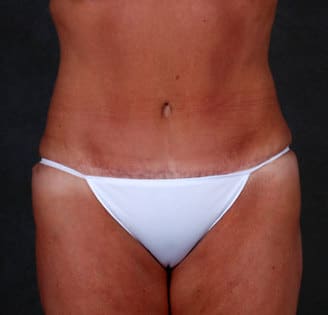 tummy tuck - patient 4880 - after 1 tummy tuck - patient 4880 - after 1