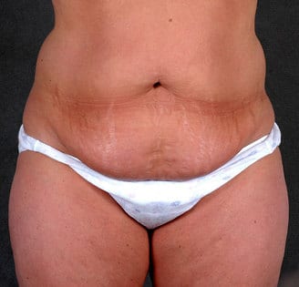 tummy tuck - patient 4880 - before 1 tummy tuck - patient 4880 - before 1