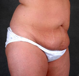 tummy tuck - patient 4880 - before 2 tummy tuck - patient 4880 - before 2
