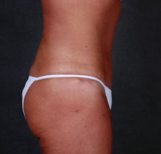 tummy tuck - patient 4880 - after 3 tummy tuck - patient 4880 - after 3