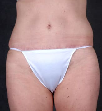 liposuction - patient 4254 - after 1 liposuction - patient 4254 - after 1
