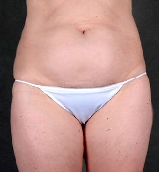 liposuction - patient 4254 - before 1 liposuction - patient 4254 - before 1