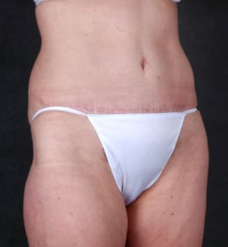 liposuction - patient 4254 - after 2 liposuction - patient 4254 - after 2