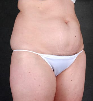 liposuction - patient 4254 - before 2 liposuction - patient 4254 - before 2