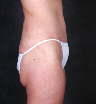 liposuction - patient 4254 - after 3 liposuction - patient 4254 - after 3