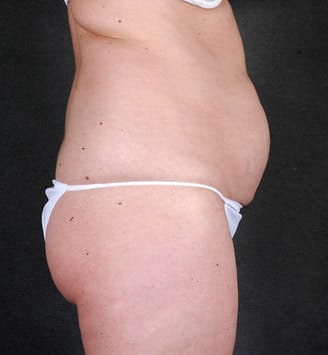liposuction - patient 4254 - before 3 liposuction - patient 4254 - before 3