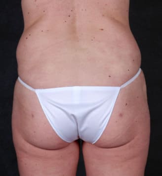 liposuction - patient 4254 - after 4 liposuction - patient 4254 - after 4