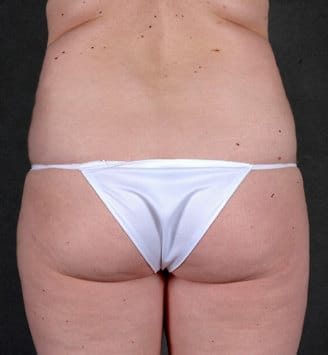 liposuction - patient 4254 - before 4 liposuction - patient 4254 - before 4