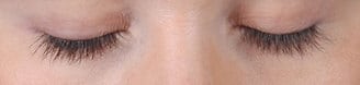 latisse - patient 6101 - after 1 latisse - patient 6101 - after 1