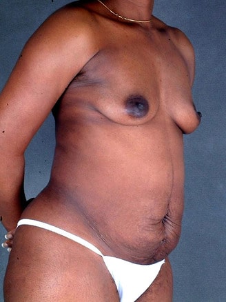 breast augmentation - patient 4928 - before 2 breast augmentation - patient 4928 - before 2