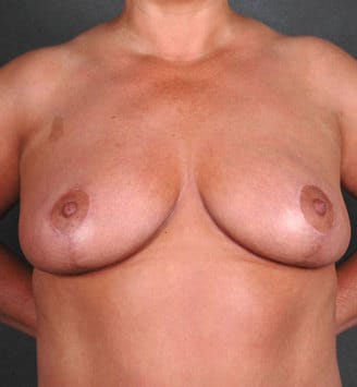 breast reduction - patient 5922 - after 1 breast reduction - patient 5922 - after 1