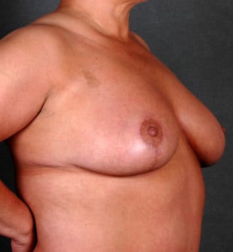 breast reduction - patient 5922 - after 2 breast reduction - patient 5922 - after 2