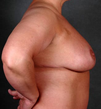 breast reduction - patient 5922 - after 3 breast reduction - patient 5922 - after 3