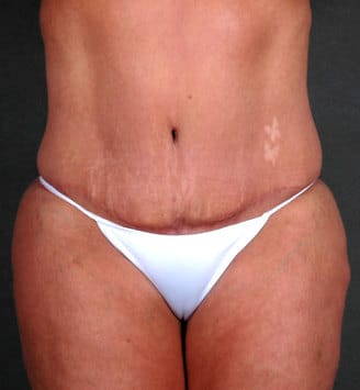 breast reduction - patient 5922 - after 4 breast reduction - patient 5922 - after 4