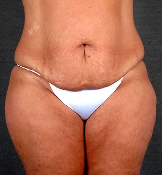breast reduction - patient 5922 - before 4 breast reduction - patient 5922 - before 4