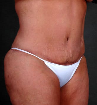 breast reduction - patient 5922 - after 5 breast reduction - patient 5922 - after 5