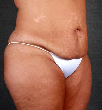 breast reduction - patient 5922 - before 5 breast reduction - patient 5922 - before 5